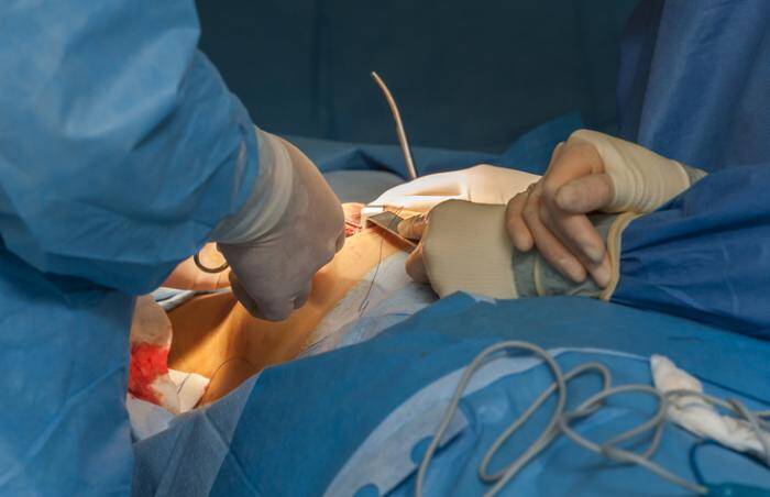 Dr Siddharth Prakash performing breast reduction in Mumbai.