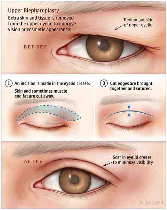 Technique of Blepharoplasty in Mumbai, Best Facial Plastic Surgeon in Mumbai.