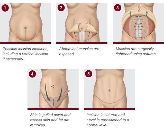 Abdominoplasty in Mumbai with Dr Siddharth Prakash