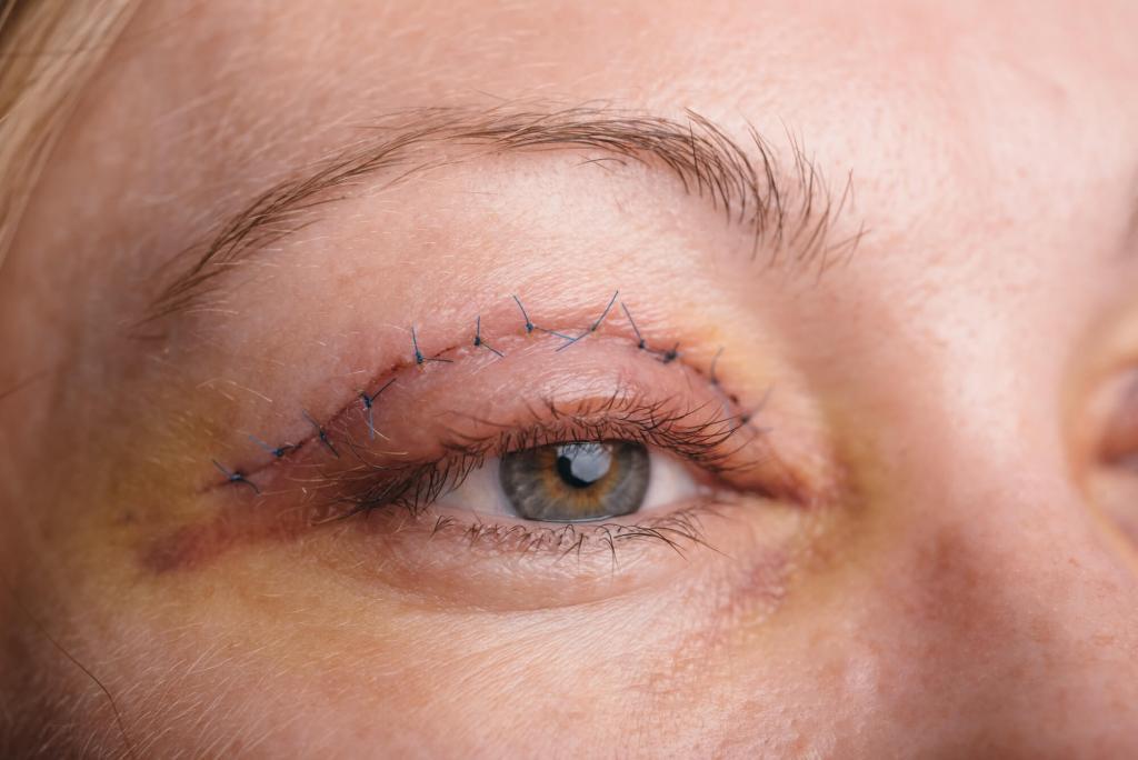 Blepharoplasty in Mumbai, eyelid lift in Mumbai