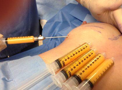 Dr Siddharth Prakash performing fat grafting to breast in Mumbai.